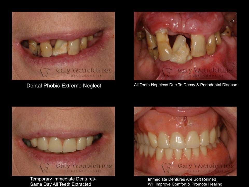 Full Mouth Extraction Dentures Erie PA 16534